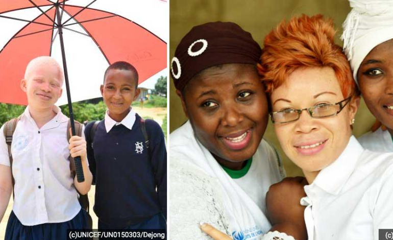 Appel &agrave; plus d'inclusion des albinos